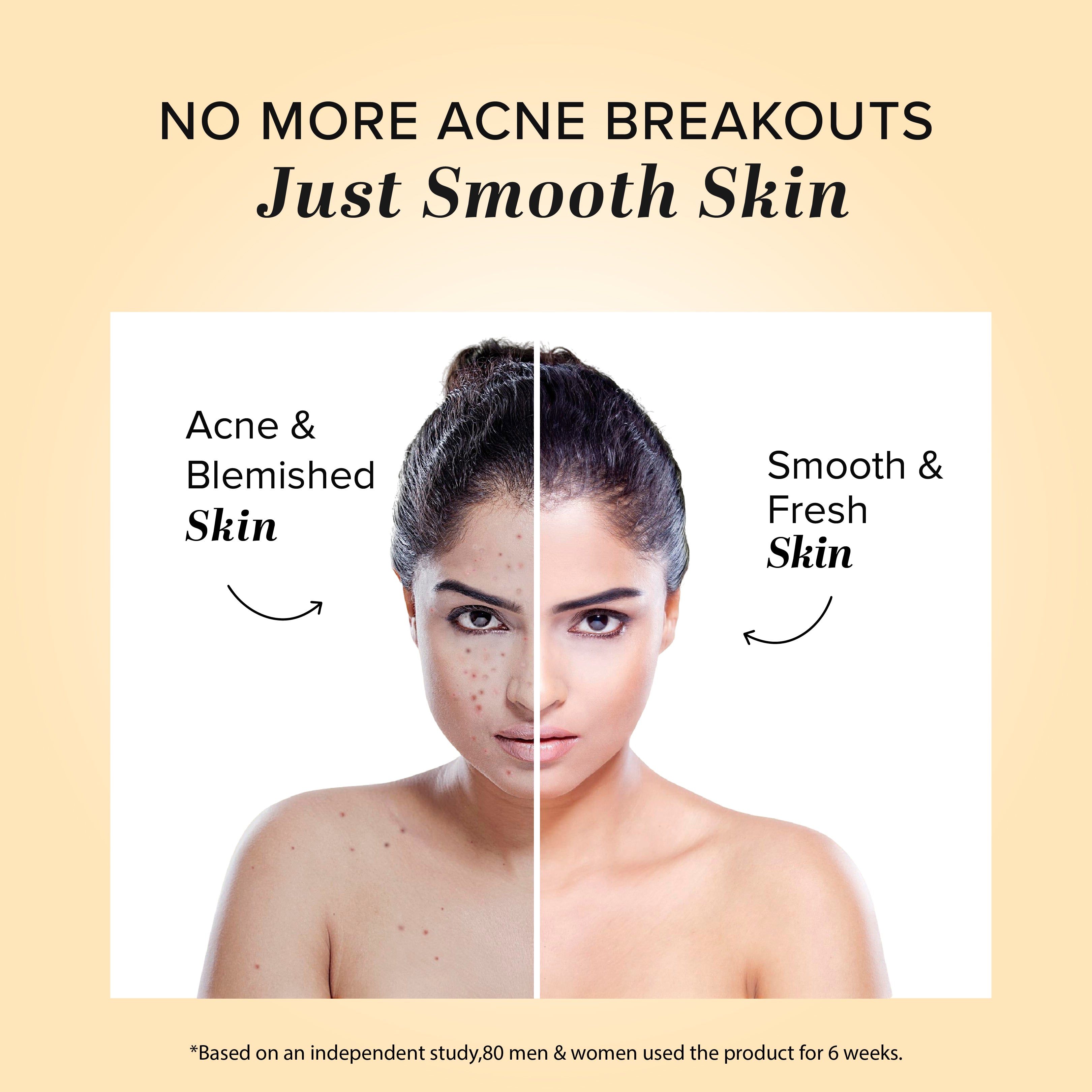 Khadi Natural Herbal Acne Pimple Cream - 50gm